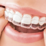 Corretivo – Alinhadores